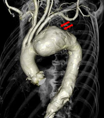 弓部大動脈瘤術前造影CT