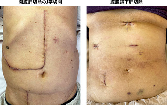 開腹肝切除と腹腔鏡下肝切除の傷の比較