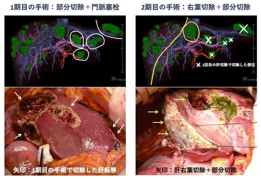 両葉多発大腸がん肝転移に対する二期的肝切除