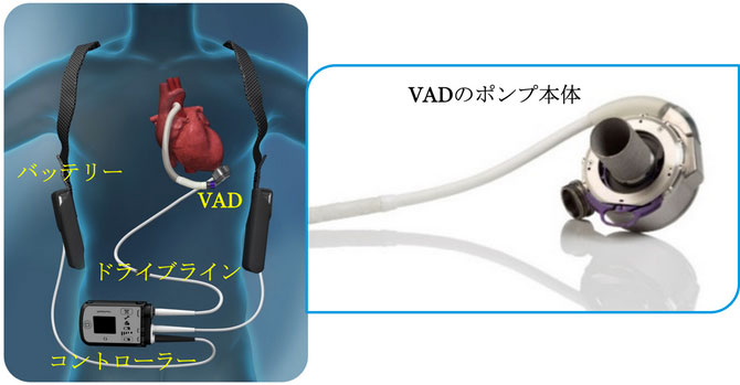 植込み型補助人工心臓（VAD：バド）